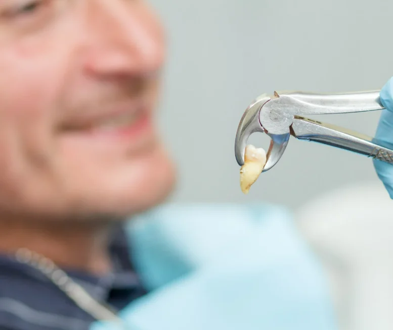 Extracted tooth held in dental forceps